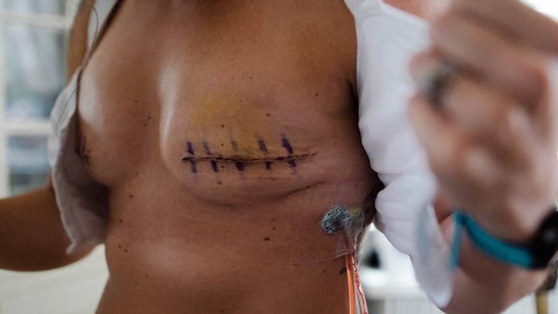 Homem se cura de câncer de pele após cirurgia cardíaca, mas ganha alergia rara