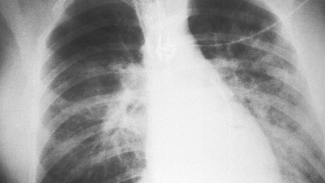 O desafio de reconhecer a fibrose pulmonar, doença rara e crônica, antes que ela evolua