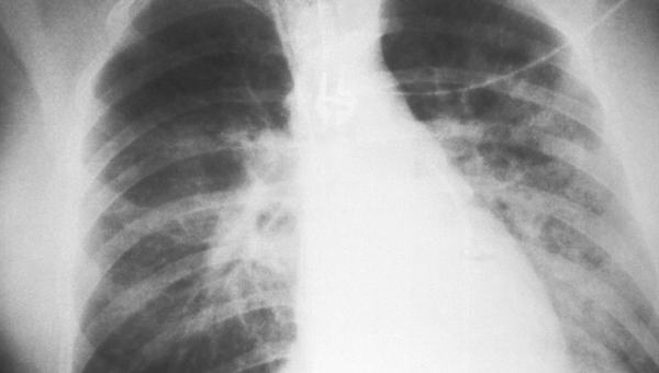 O desafio de reconhecer a fibrose pulmonar, doença rara e crônica, antes que ela evolua
